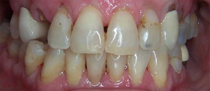 CEREC Dental Crown Before