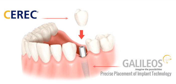 cerec-dental-implants