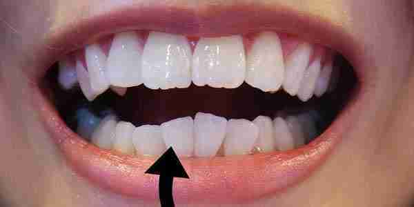 Invisalign Before