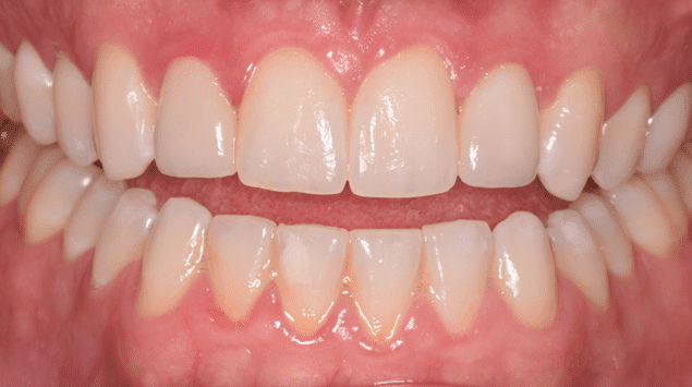 Teeth Whitening After