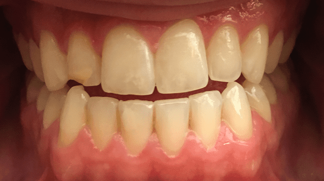 Teeth Whitening Before