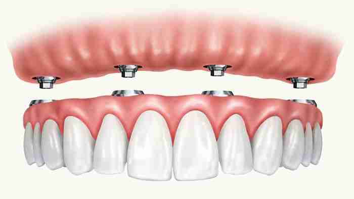 All On 4 Implants NYC
