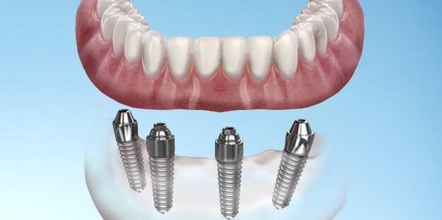 Costs of Full Mouth Dental Implants