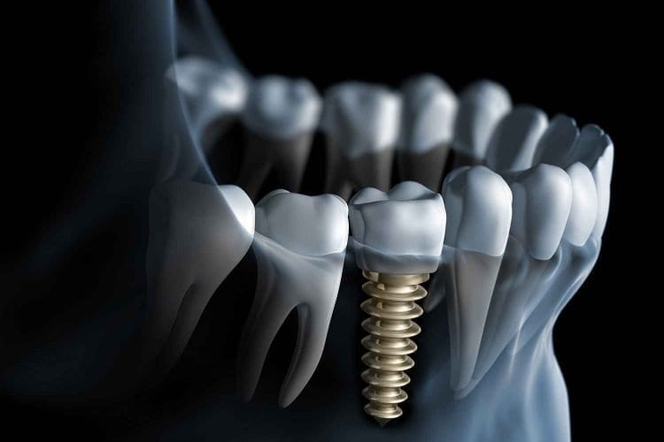 Dental Implants Ottawa
