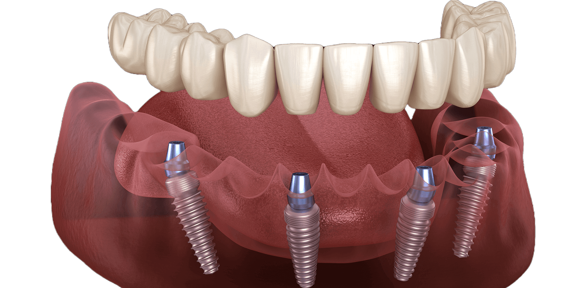What Happens if All-on-4 Dental Implants Fail?