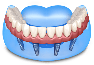 All On 4 Dental Implants NYC