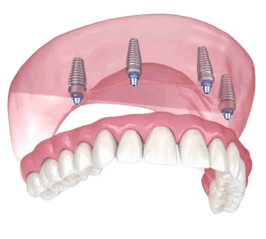 4 Implant Denture