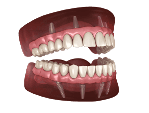 Full Mouth Dental Implants