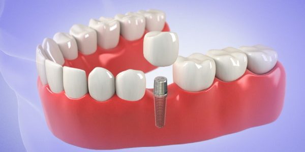 Same-day dental implnts